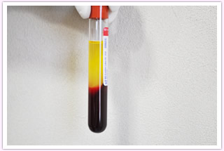 遠心分離が終わった状態の採血血液